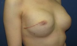 nipple saving 1